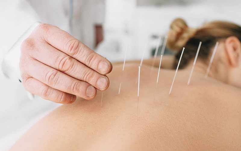 châm cứu cổ truyền