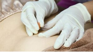 cấy chỉ đông y