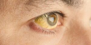 Dấu hiệu trên khuôn mặt cảnh báo dạ dày suy yếu