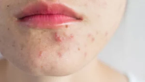 Dấu hiệu trên khuôn mặt cảnh báo dạ dày suy yếu